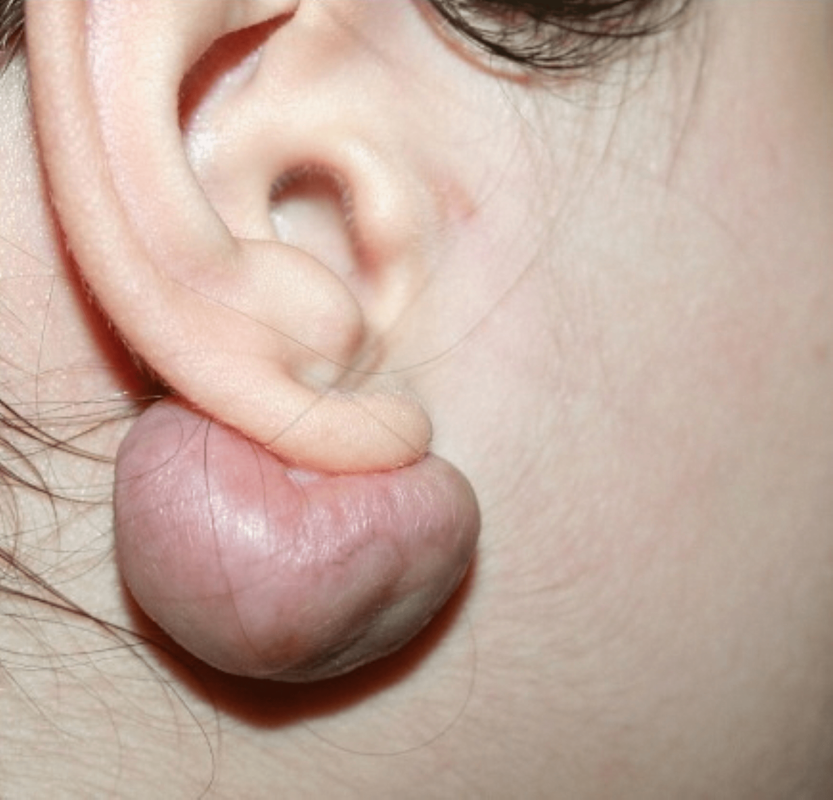 A keloid in an anatomical area typical for these lesions, following earring placement